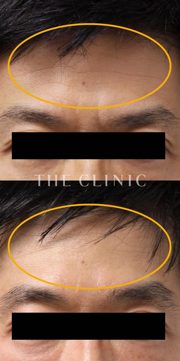 額のシワのマイクロCRF注入(顔の脂肪注入)（53歳男性）の術前・術後写真