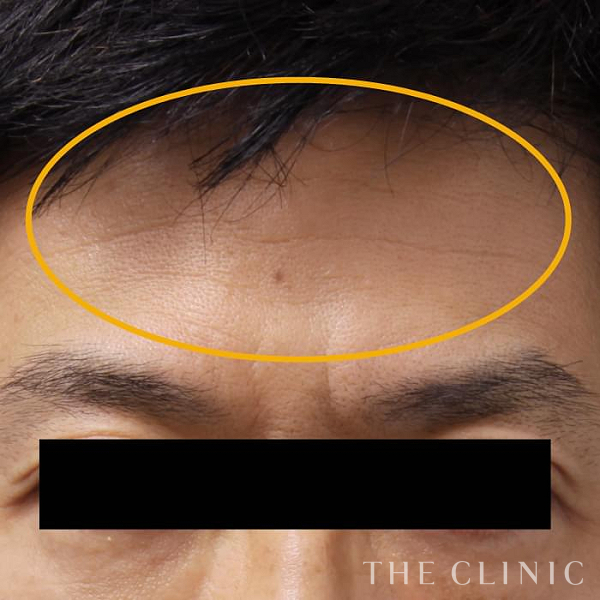 額のシワのマイクロCRF注入(顔の脂肪注入)（53歳男性）の術前写真