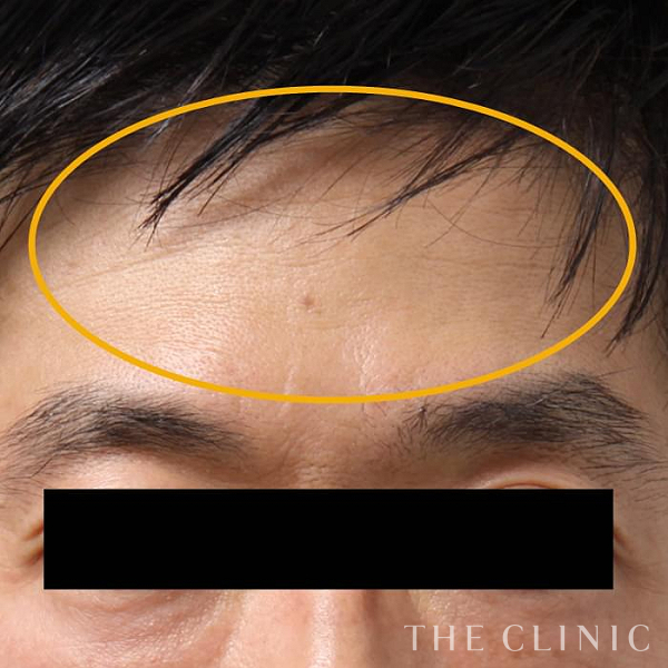 額のシワのマイクロCRF注入(顔の脂肪注入)（53歳男性）の術後写真