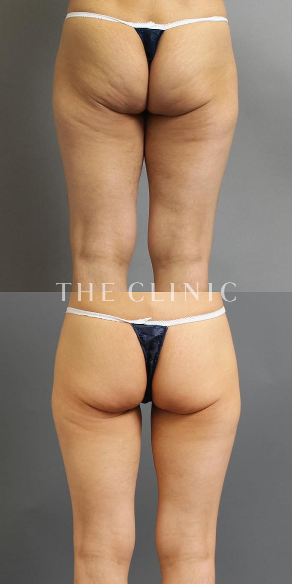 太もものベイザー脂肪吸引（43歳女性）の術前・術後写真