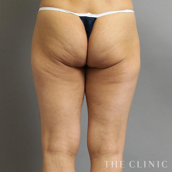 太もものベイザー脂肪吸引（43歳女性）の術前写真
