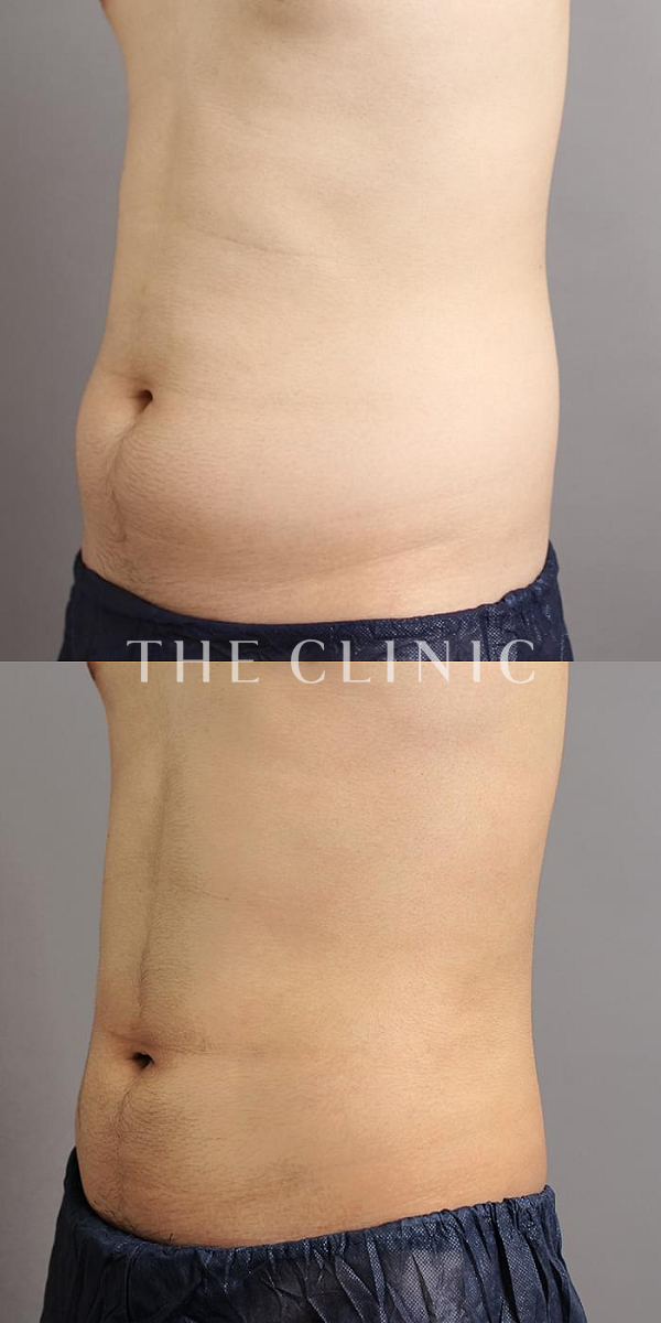 腹部・腰・ウエストのベイザー脂肪吸引（26歳男性）の術前・術後写真