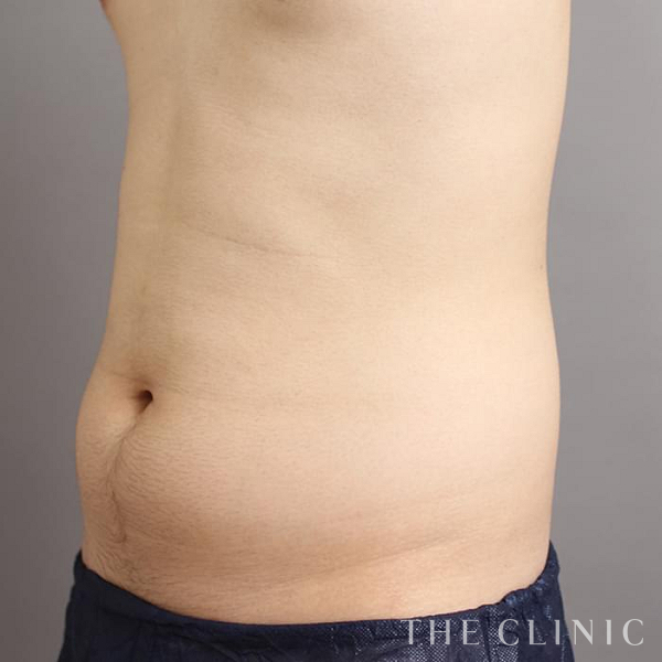 腹部・腰・ウエストのベイザー脂肪吸引（26歳男性）の術前写真