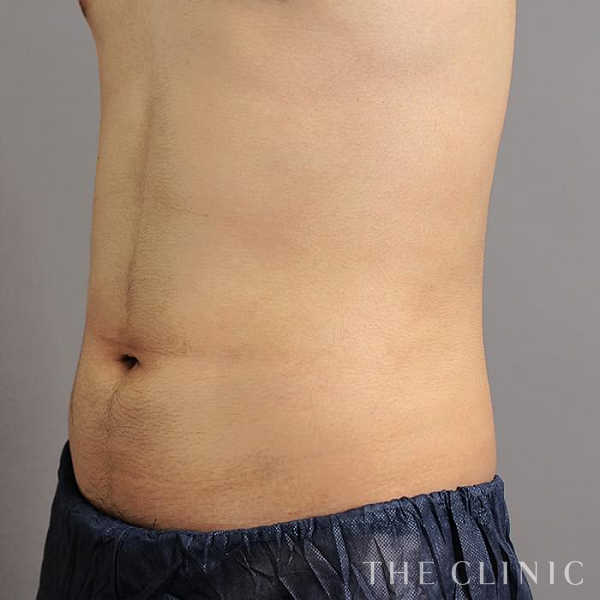 腹部・腰・ウエストのベイザー脂肪吸引（26歳男性）の術後写真