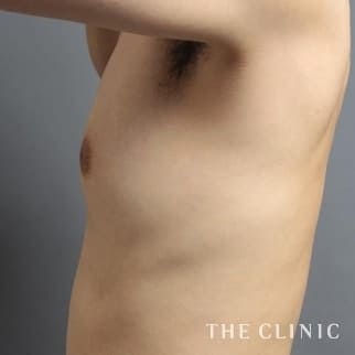 【THE CLINIC 症例画像】No.584_1_偽性女性化乳房_女性化乳房治療(男性の胸の膨らみ改善)(執刀医:)