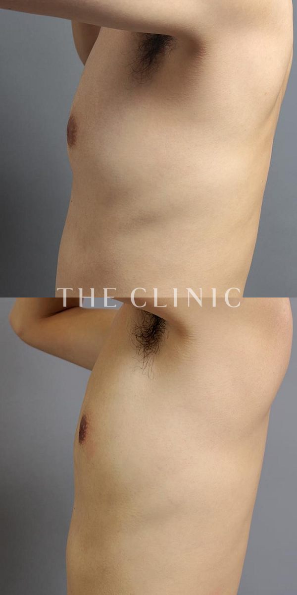 偽性女性化乳房の女性化乳房治療(男性の胸の膨らみ改善)（34歳男性）の術前・術後写真