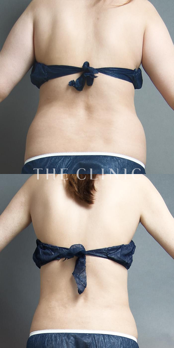 腰・ウエストのベイザー脂肪吸引（23歳女性）の術前・術後写真