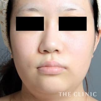 【THE CLINIC 症例画像】No.587_1_頰/顎_360脂肪吸引®(執刀医:大橋 昌敬)