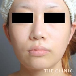 【THE CLINIC 症例画像】No.587_2_頰/顎_ベイザー脂肪吸引(執刀医:大橋 昌敬)