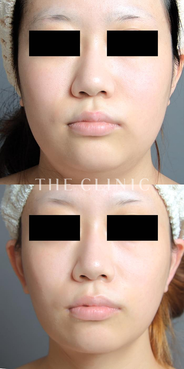 頰／顎のベイザー脂肪吸引（23歳女性）の術前・術後写真