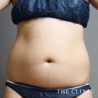 【THE CLINIC 症例画像】No.588_1_腹部_360脂肪吸引®(執刀医:大橋 昌敬)