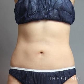 【THE CLINIC 症例画像】No.588_2_腹部_360脂肪吸引®(執刀医:大橋 昌敬)