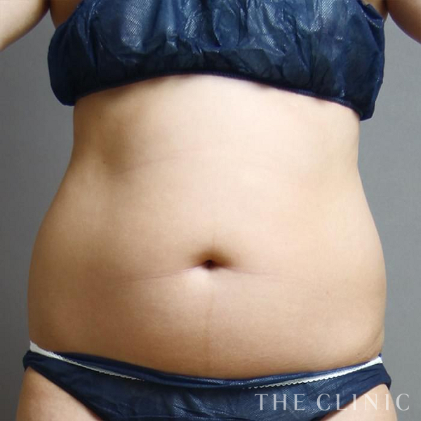 腹部・腰・ウエストのベイザー脂肪吸引（23歳女性）の術前写真