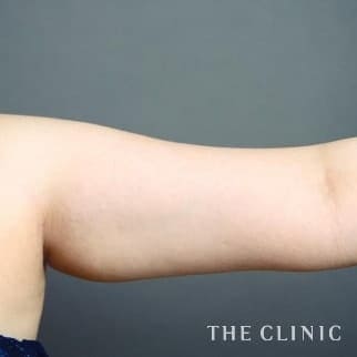 症例写真 / ベイザー脂肪吸引 術前