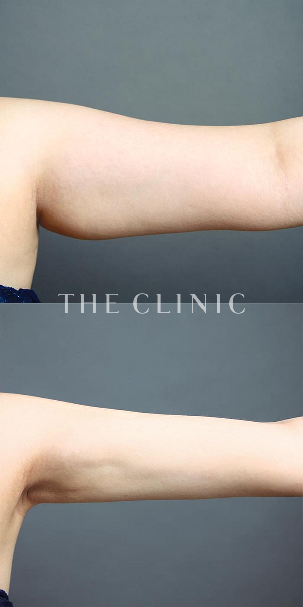 二の腕のベイザー脂肪吸引（23歳女性）の術前・術後写真
