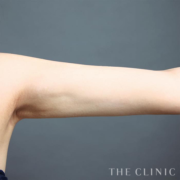 二の腕のベイザー脂肪吸引（23歳女性）の術後写真