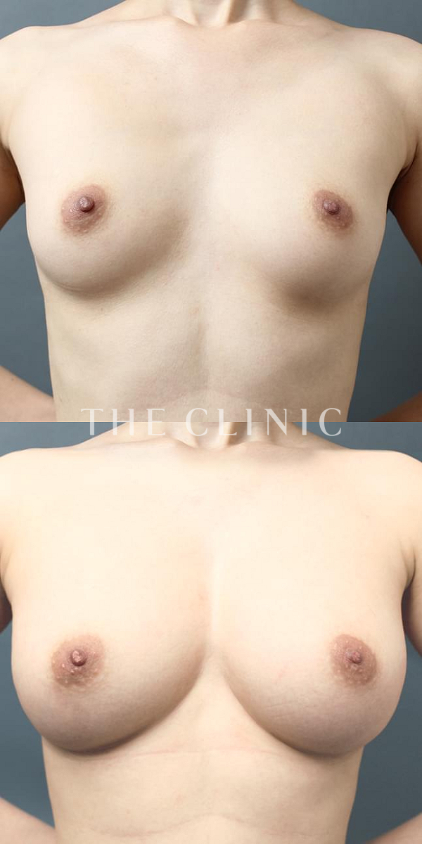 ボリュームアップのコンデンスリッチ豊胸（29歳女性）の術前・術後写真