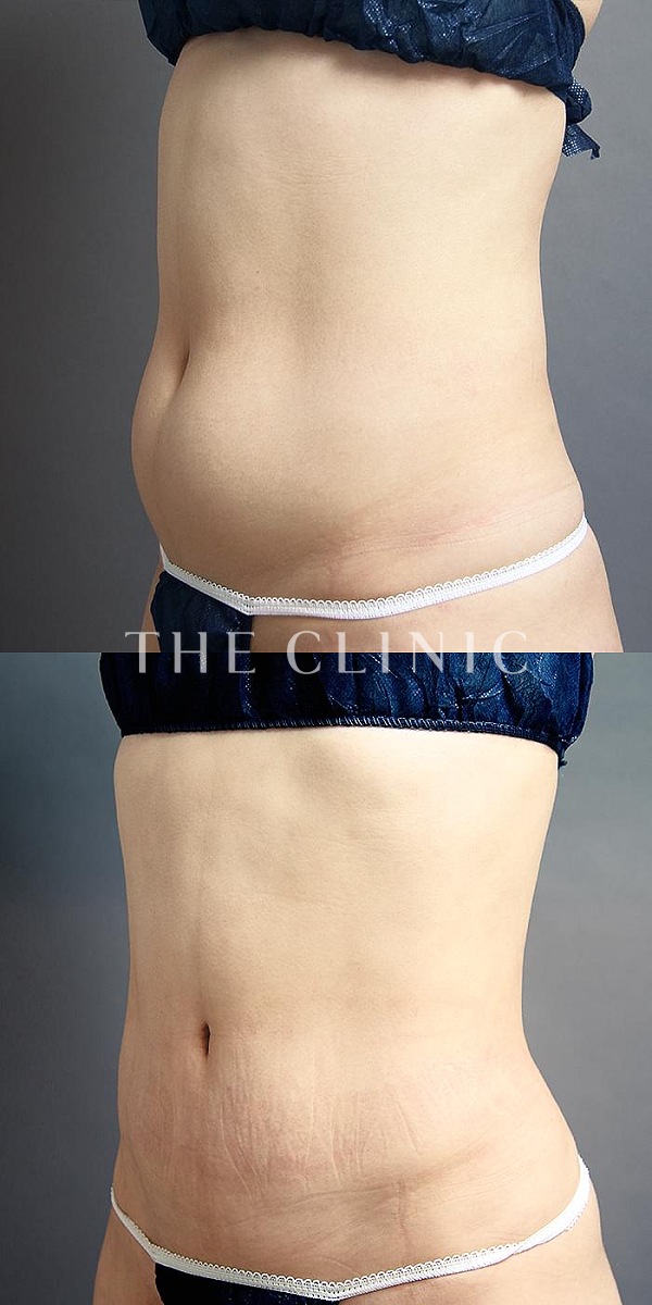 腹部・腰・ウエストのベイザー脂肪吸引（39歳女性）の術前・術後写真