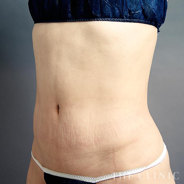 腹部・腰・ウエストのベイザー脂肪吸引（39歳女性）の術後写真
