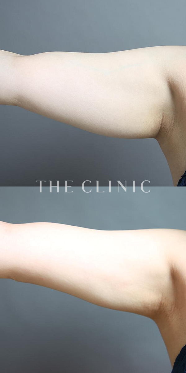 二の腕のベイザー脂肪吸引（39歳女性）の術前・術後写真