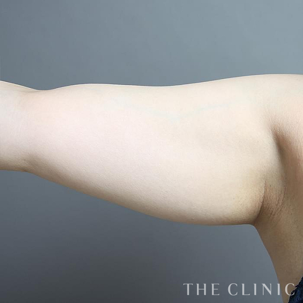 二の腕のベイザー脂肪吸引（39歳女性）の術前写真