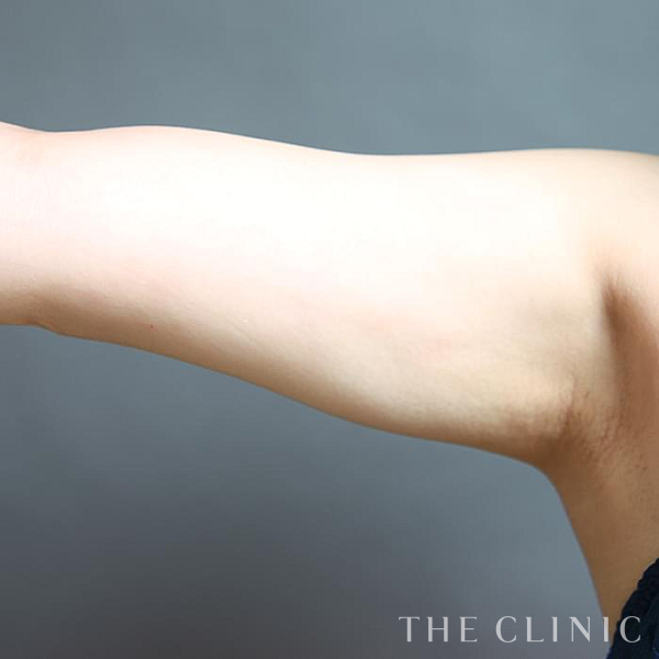 二の腕のベイザー脂肪吸引（39歳女性）の術後写真