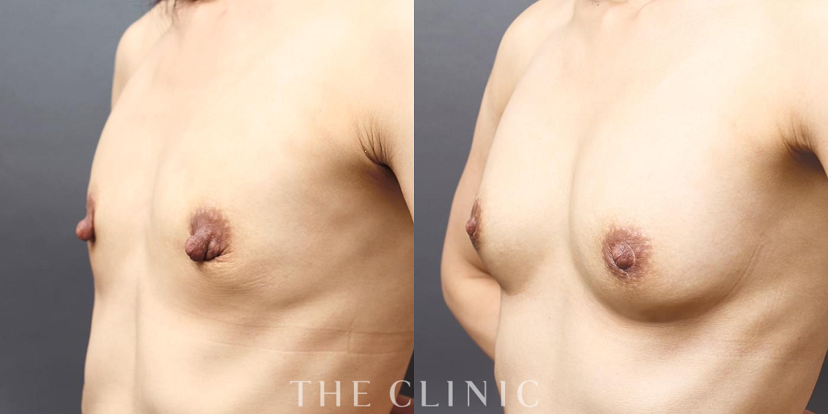 コンデンスリッチ豊胸の術前/術後