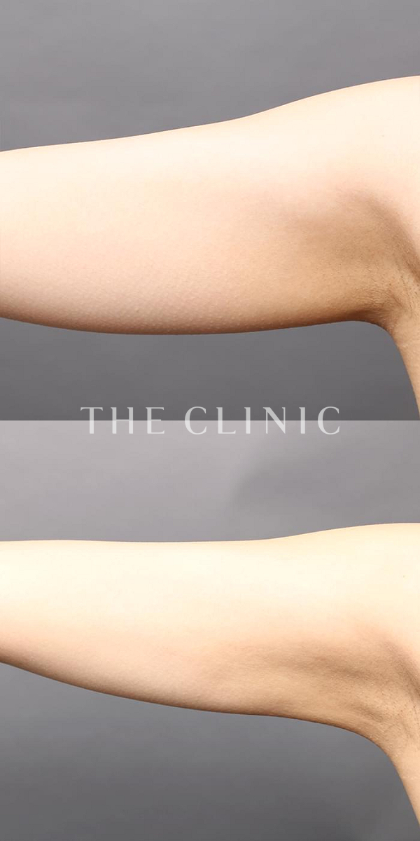 二の腕のベイザー脂肪吸引（31歳女性）の術前・術後写真