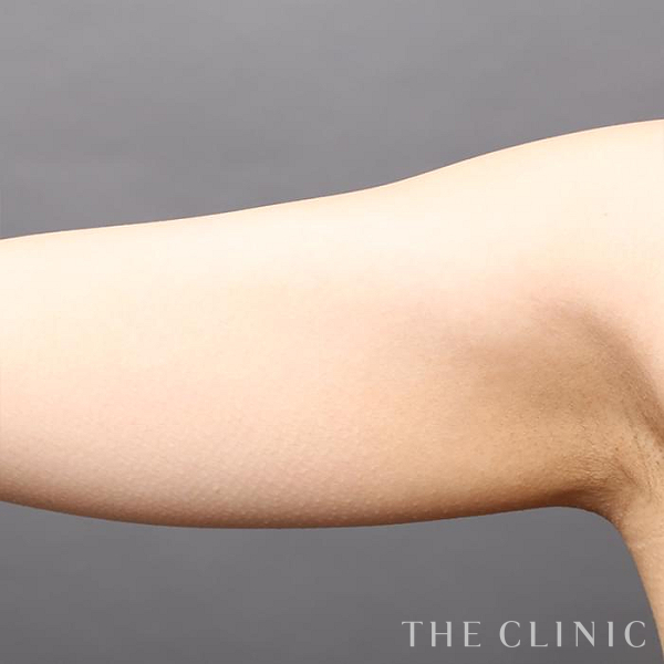 二の腕のベイザー脂肪吸引（31歳女性）の術前写真