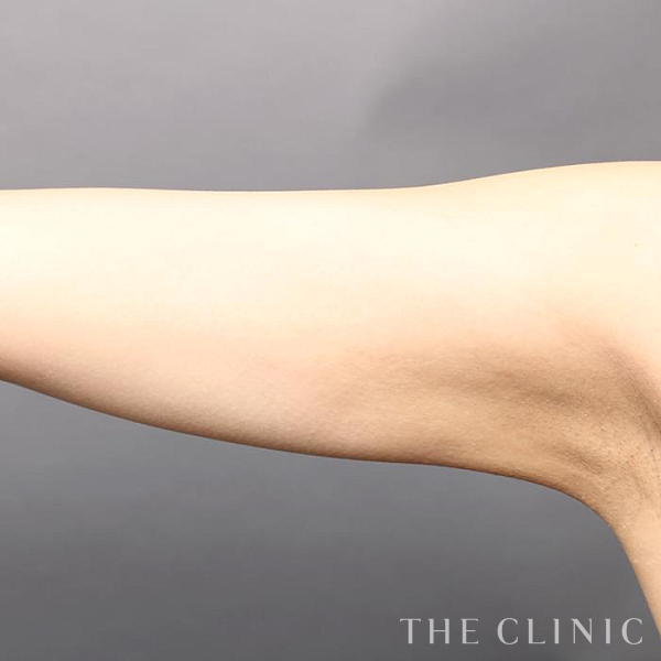 二の腕のベイザー脂肪吸引（31歳女性）の術後写真