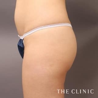 【THE CLINIC 症例画像】No.598_1_ヒップアップ_ヒップメイク by 360脂肪吸引®(執刀医:大橋 昌敬)