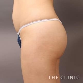 【THE CLINIC 症例画像】No.598_2_ヒップアップ_ヒップメイク by 360脂肪吸引®(執刀医:大橋 昌敬)