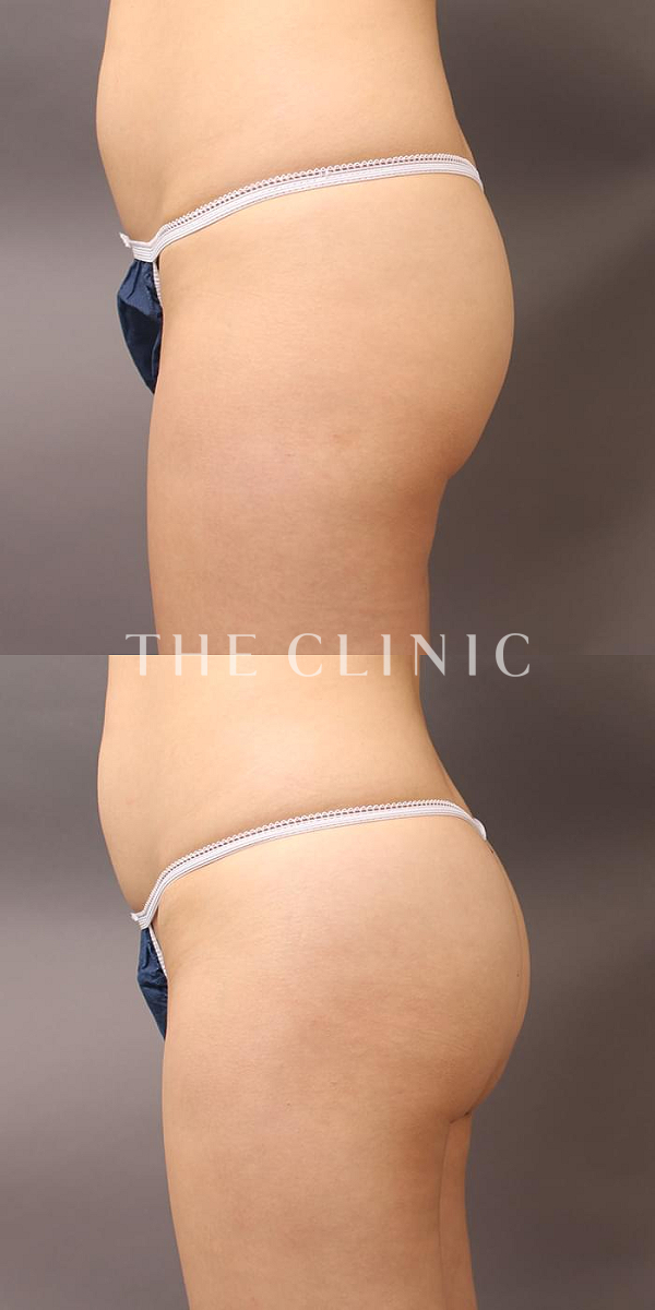 ヒップアップのヒップメイク by 360脂肪吸引®（25歳女性）の術前・術後写真