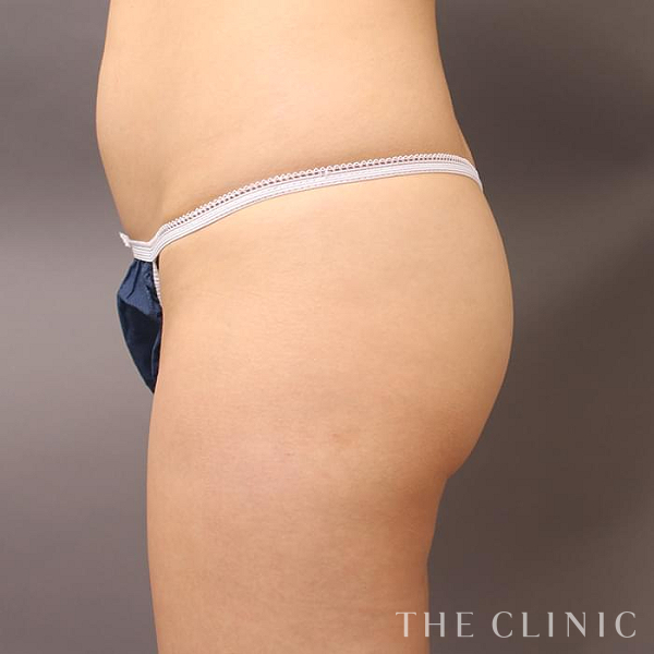 ヒップアップのヒップメイク by 360脂肪吸引®（25歳女性）の術前写真