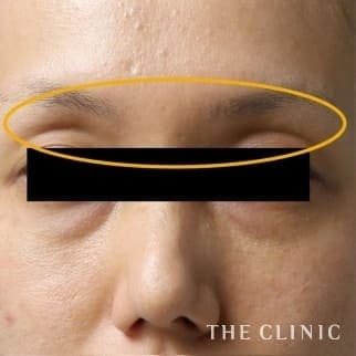 【THE CLINIC 症例画像】No.59_1_目の上のくぼみ_マイクロCRF注入(顔の脂肪注入)(執刀医:大橋 昌敬)