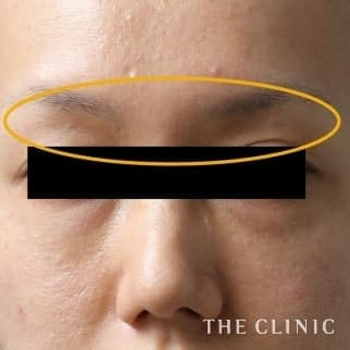 【THE CLINIC 症例画像】No.59_2_目の上のくぼみ_マイクロCRF注入(顔の脂肪注入)(執刀医:大橋 昌敬)