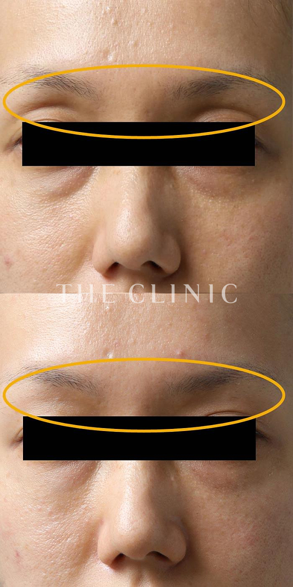 目の上のくぼみのマイクロCRF注入(顔の脂肪注入)（34歳女性）の術前・術後写真