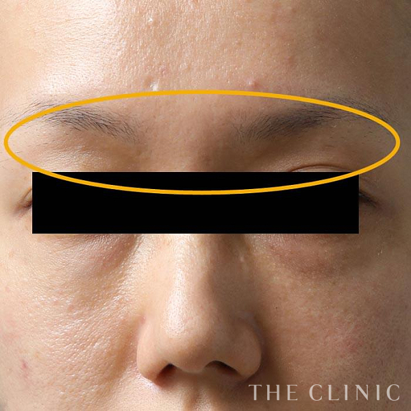 目の上のくぼみのマイクロCRF注入(顔の脂肪注入)（34歳女性）の術後写真