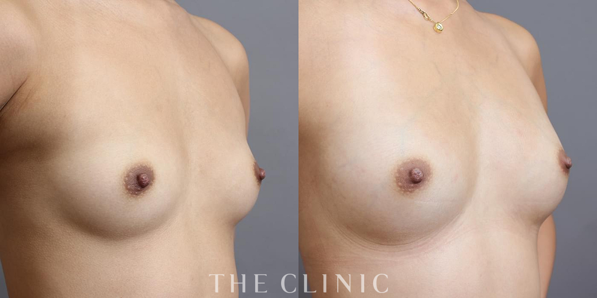 コンデンスリッチ豊胸の術前/術後