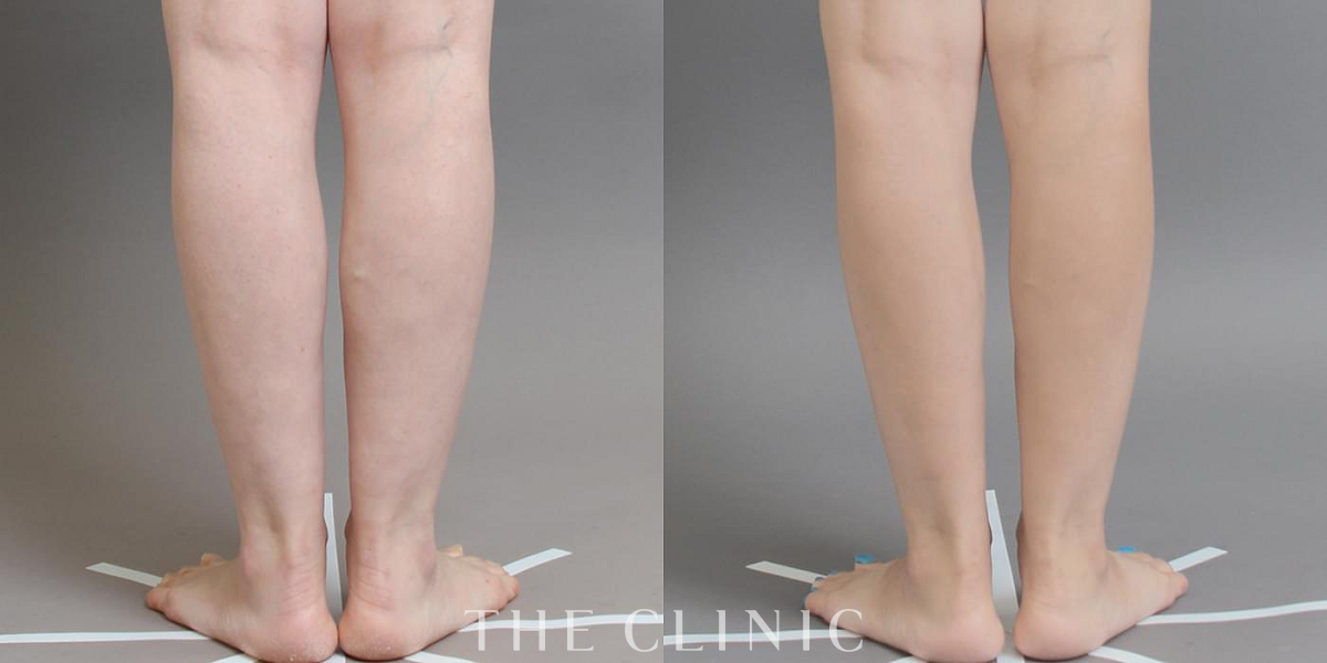 ベイザー脂肪吸引の術前／術後