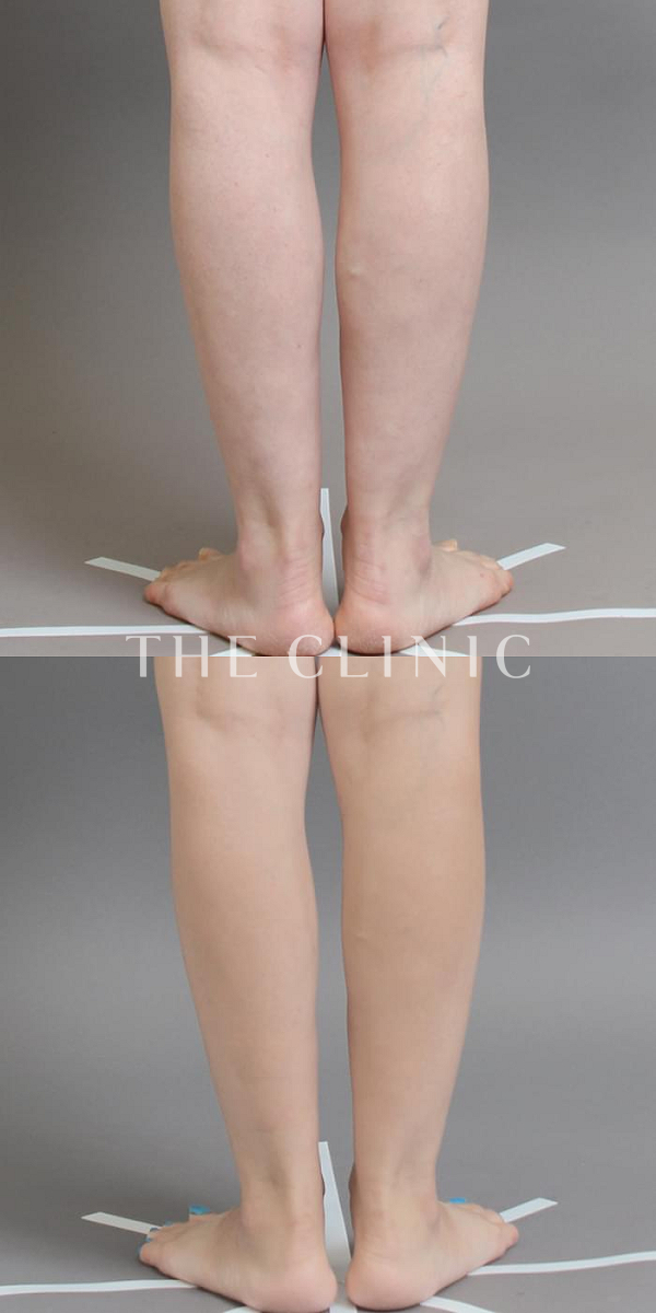 ふくらはぎのベイザー脂肪吸引（34歳女性）の術前・術後写真
