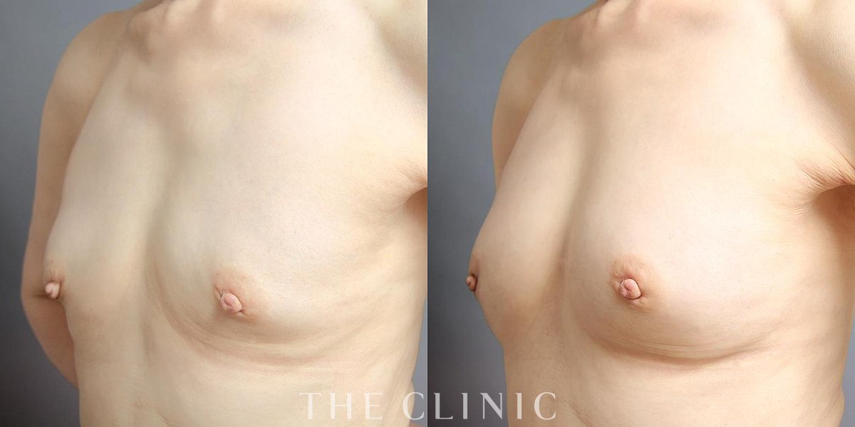 コンデンスリッチ豊胸の術前/術後