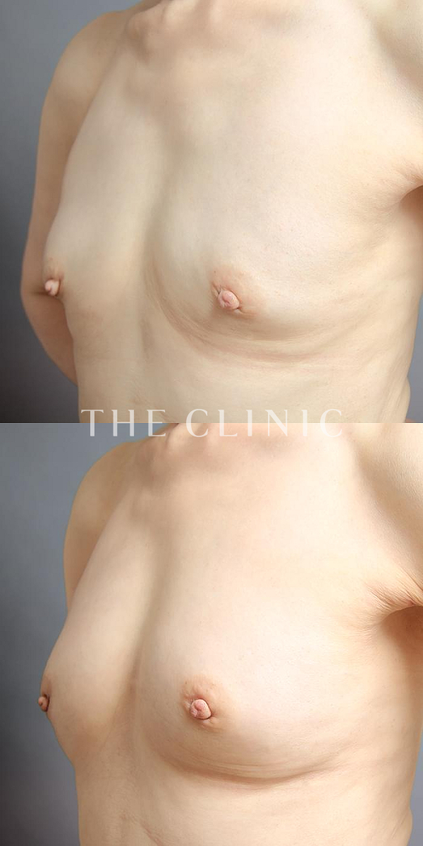 ボリュームアップのコンデンスリッチ豊胸（67歳女性）の術前・術後写真