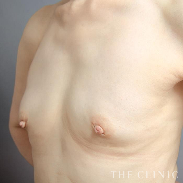 ボリュームアップのコンデンスリッチ豊胸（67歳女性）の術前写真