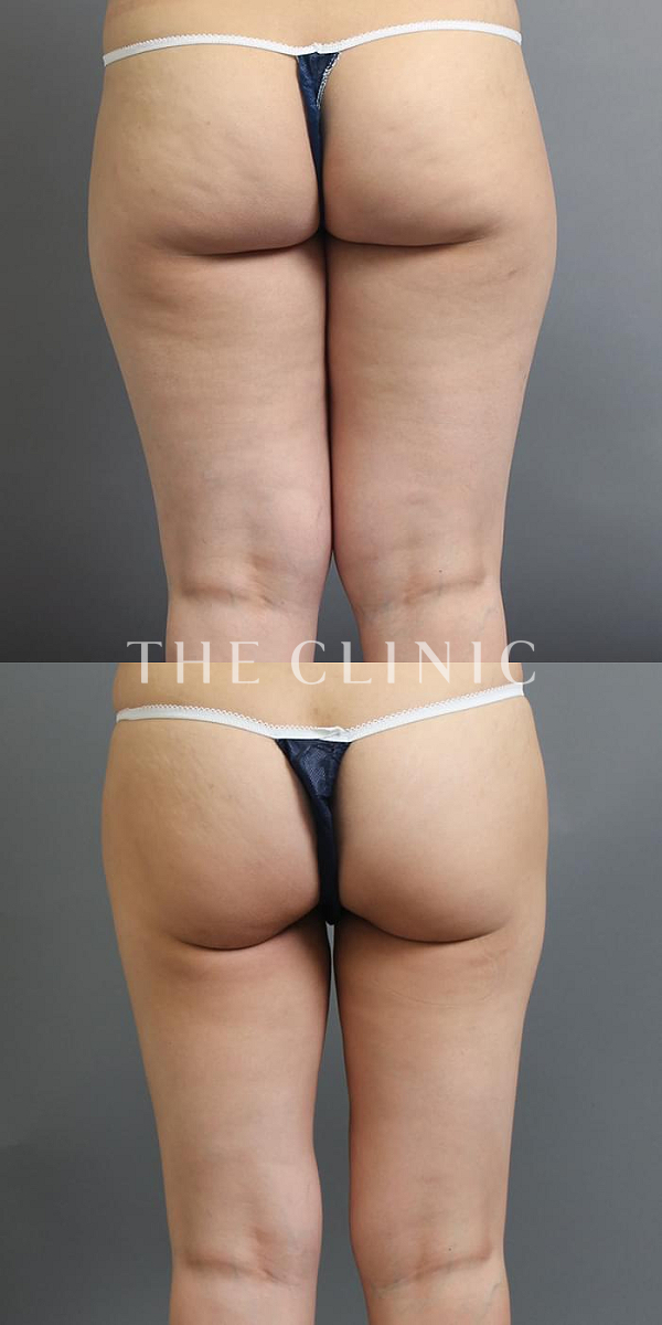 太もものベイザー脂肪吸引（24歳女性）の術前・術後写真