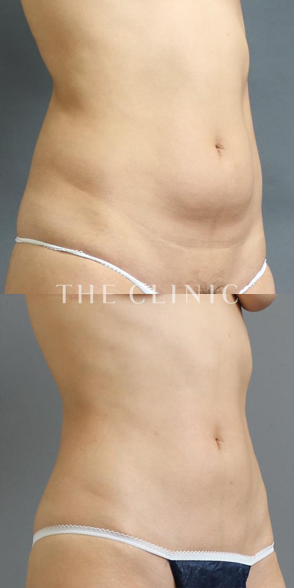 腹部のベイザー脂肪吸引（24歳女性）の術前・術後写真