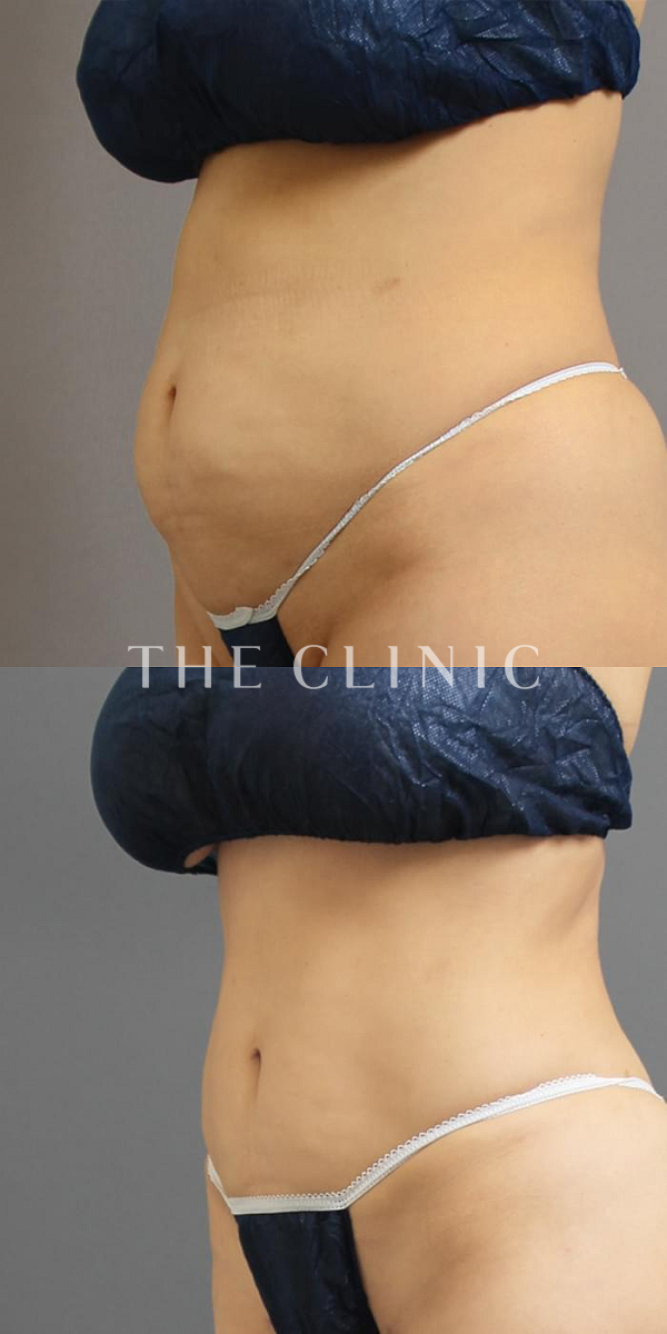 腹部のベイザー脂肪吸引（51歳女性）の術前・術後写真