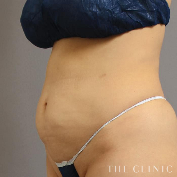 腹部のベイザー脂肪吸引（51歳女性）の術前写真