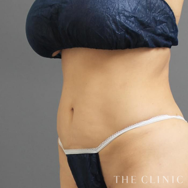 腹部のベイザー脂肪吸引（51歳女性）の術後写真