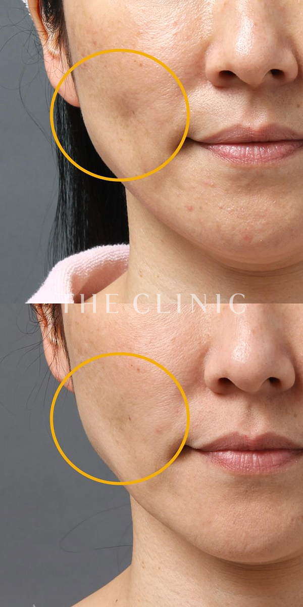 こけた頬のマイクロCRF注入(顔の脂肪注入)（40歳女性）の術前・術後写真